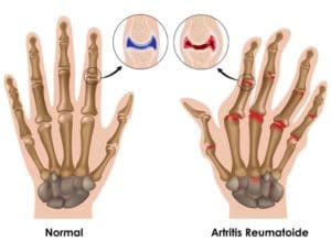 Illustration de la polyarthrite rhumatoïde sur les mains